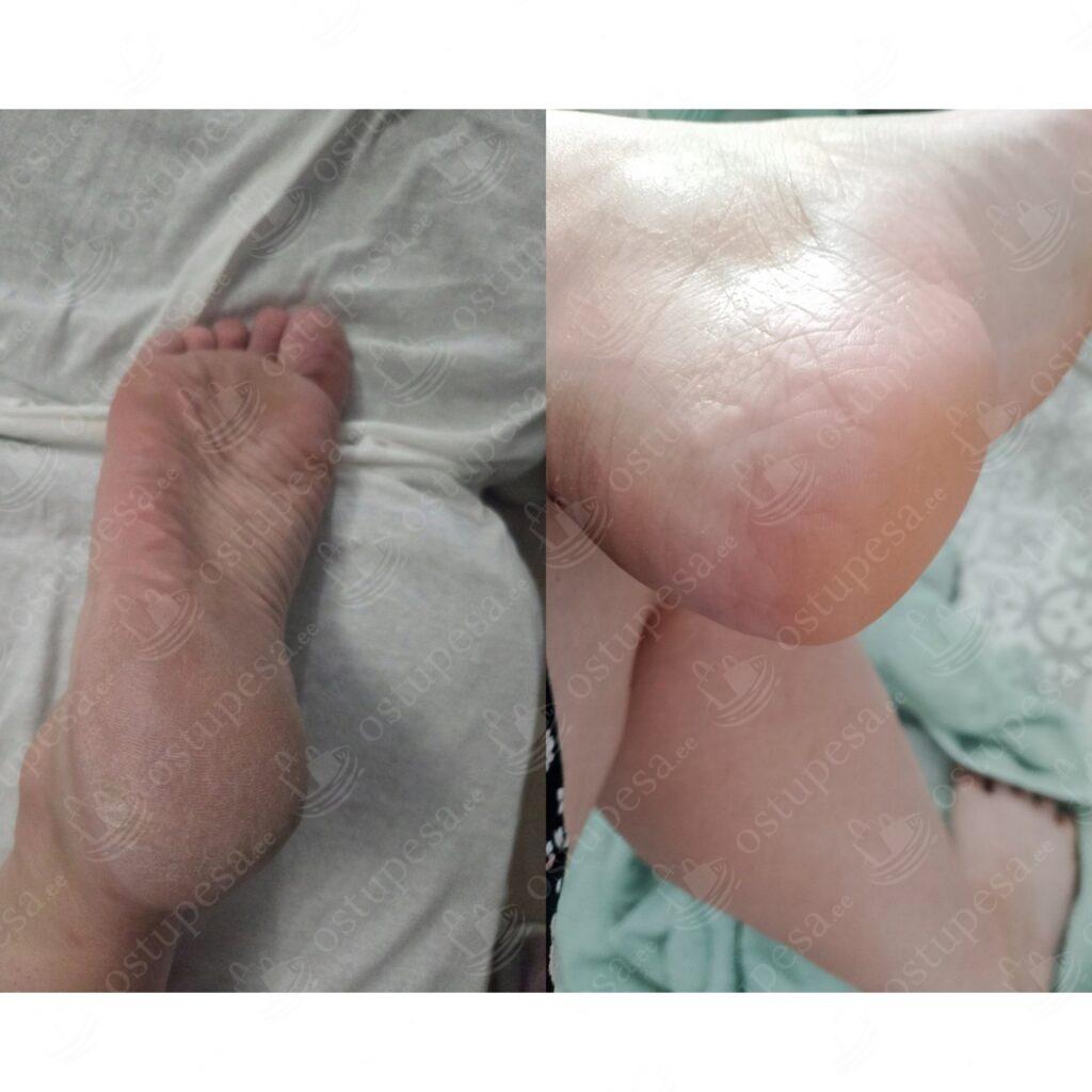 Nahapaksendite ja küünenahkade eemaldaja, HornEx, 250 ml